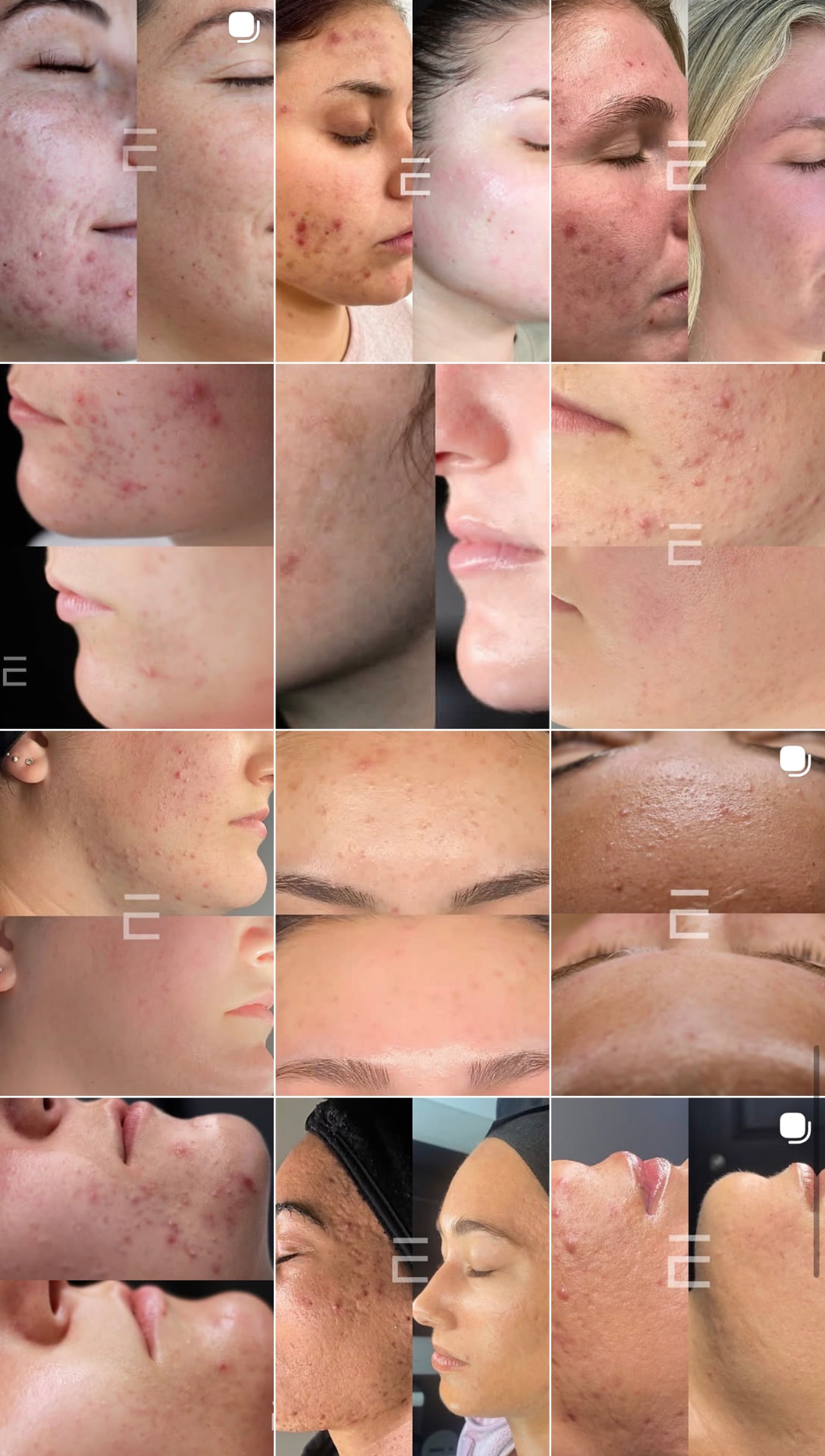 Before and after progress photos of skin health over time